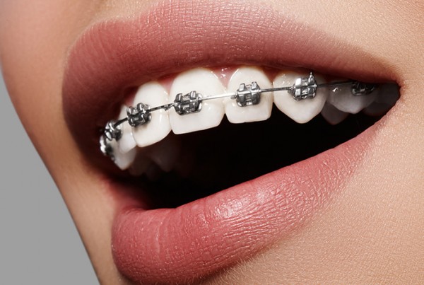 tips for improving your braces treatment